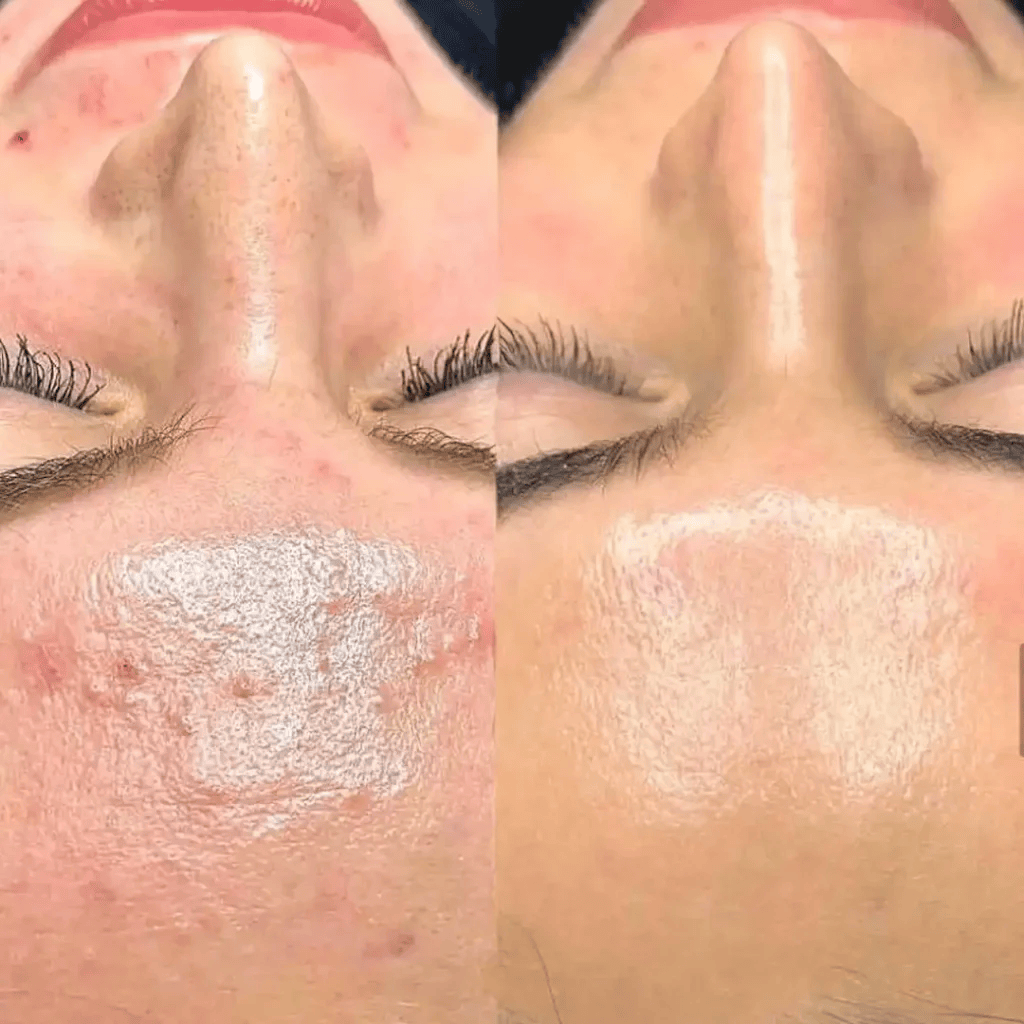 BioRePeel в Maya Skin & Brow Studio, Мидтаун Манхэттен