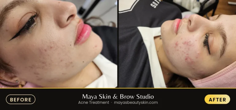 Acne Treatment before and after, real client at Maya Skin & Brow Studio, Midtown Manhattan