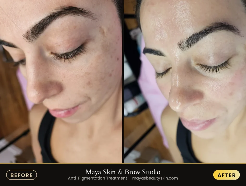 Anti-Pigmentation Treatment before and after, real client at Maya Skin & Brow Studio, Midtown Manhattan