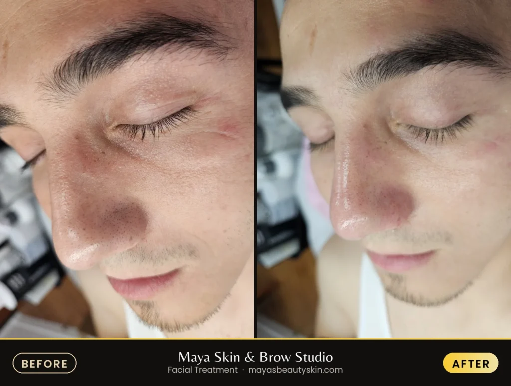 Facial Treatment before and after, real client at Maya Skin & Brow Studio, Midtown Manhattan