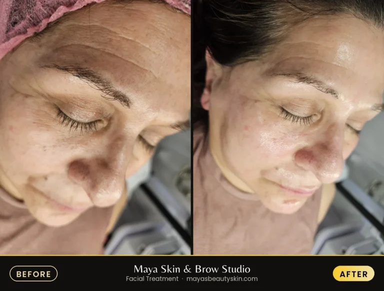 Anti-Aging Treatment before and after, real client at Maya Skin & Brow Studio, Midtown Manhattan